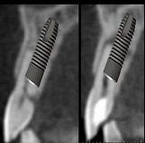 Implant planning